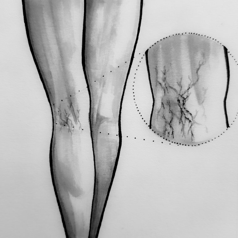 Pajączki pod kolanami 