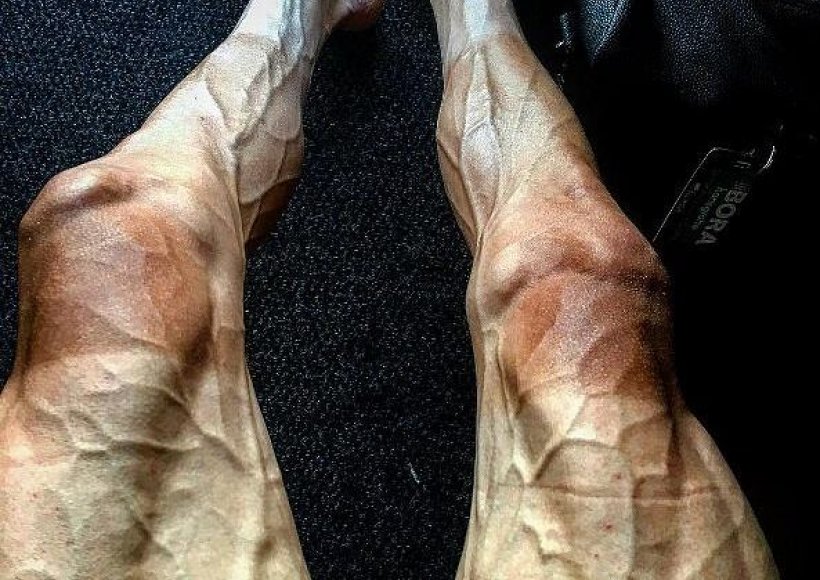 Poszerzone żyły u sportowców – czy to jest normalne ? Czy to już choroba. 