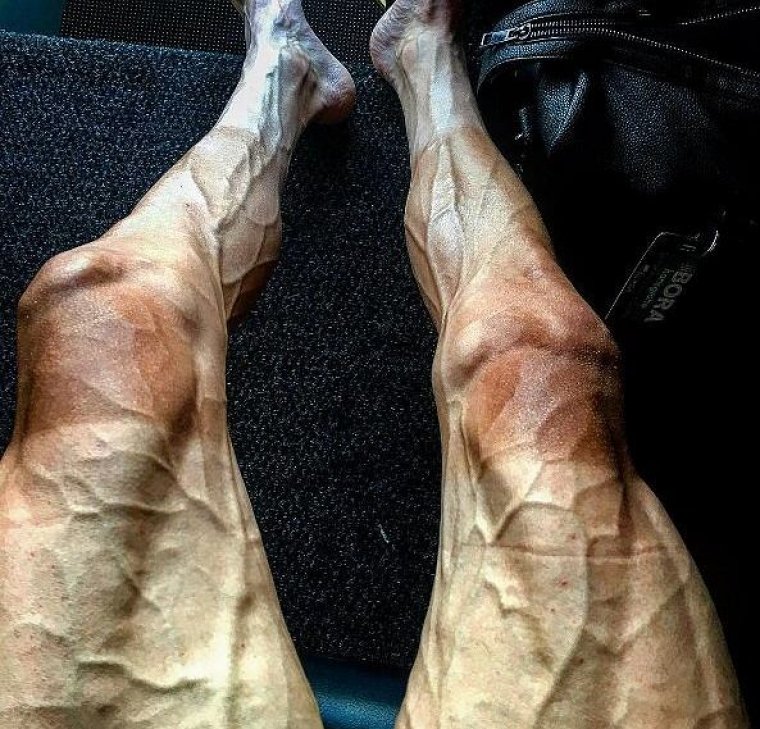 Poszerzone żyły u sportowców – czy to jest normalne ? Czy to już choroba. 