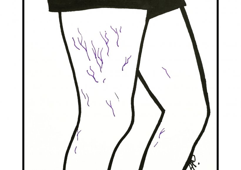 Pajączki na bocznej stronie uda 