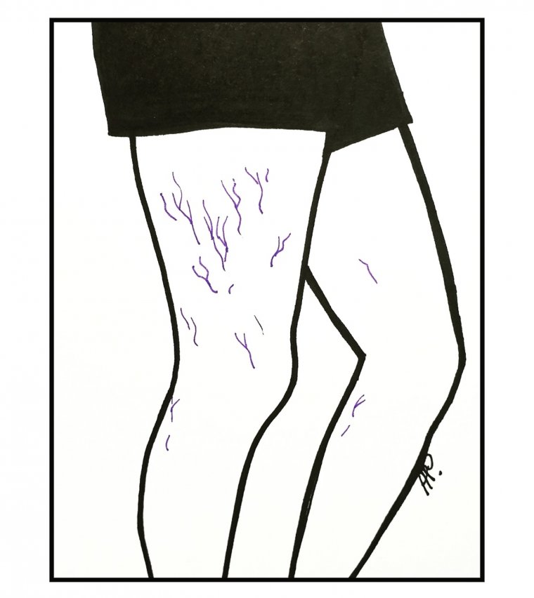 Pajączki na bocznej stronie uda 