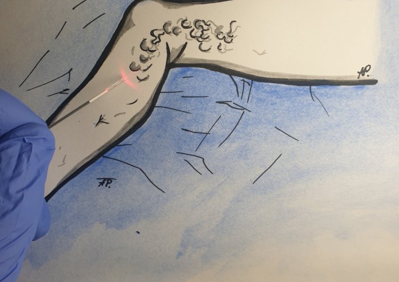 Laserowe usuwanie żylaków