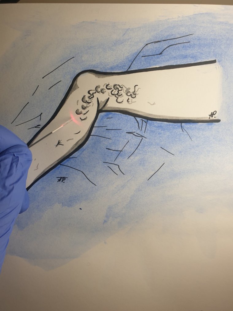 Laserowe usuwanie żylaków