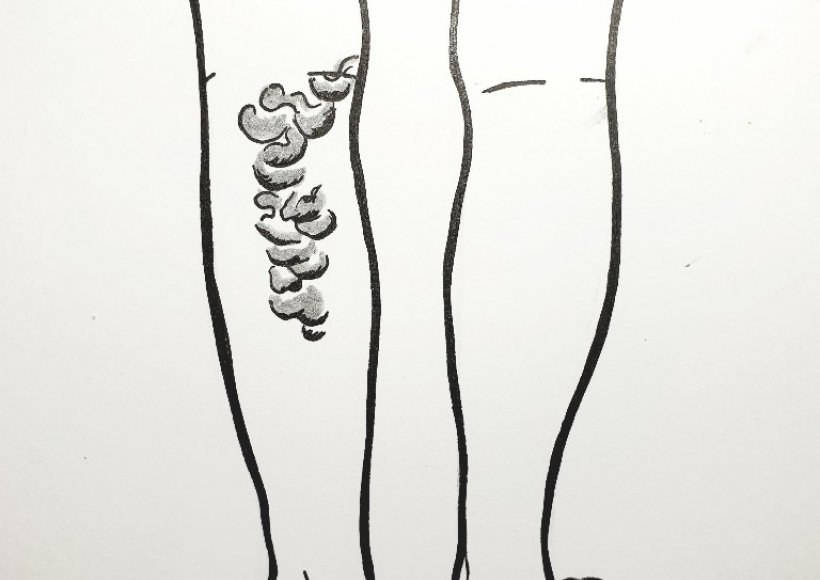 Żylaki na tylnej stronie łydki 