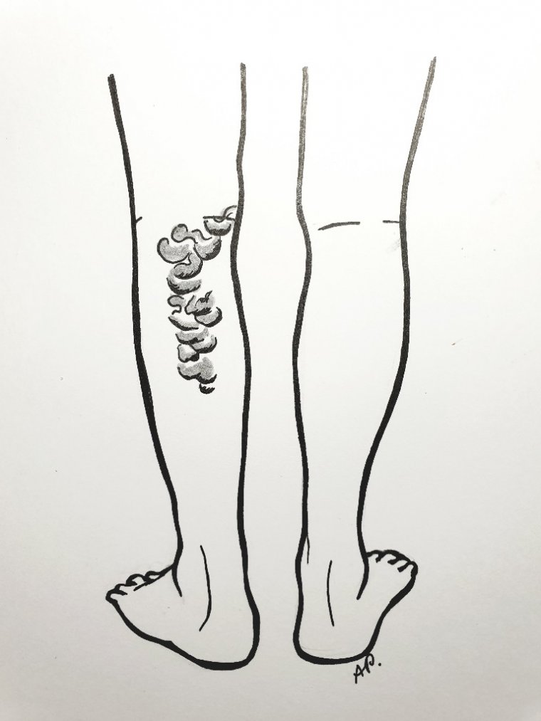 Żylaki na tylnej stronie łydki 