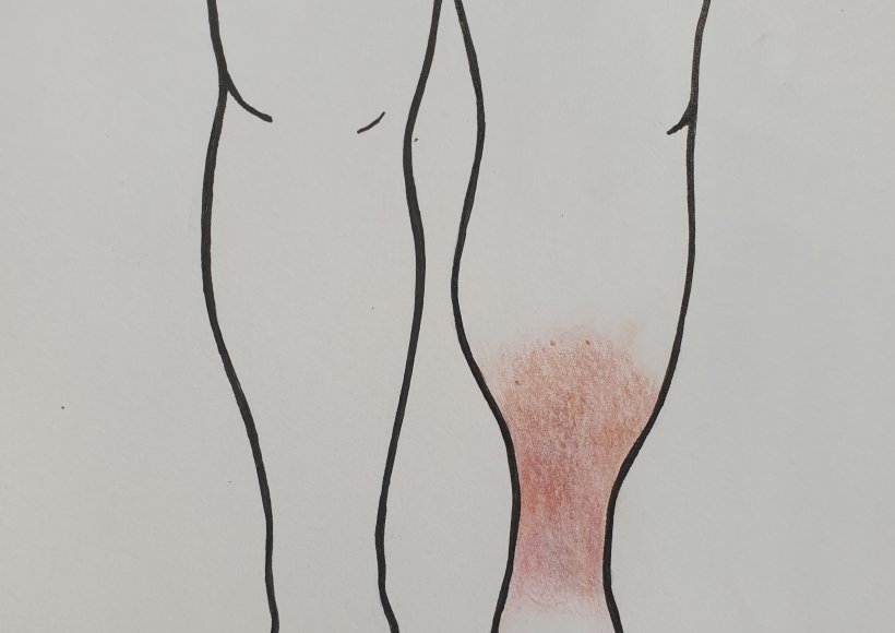 Wyprysk żylakowaty (Stasis Dermatitis)