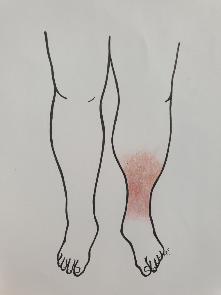Wyprysk żylakowaty (Stasis Dermatitis)