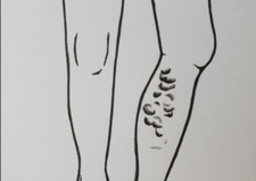 Żylaki po przyśrodkowej stronie uda i na łydce