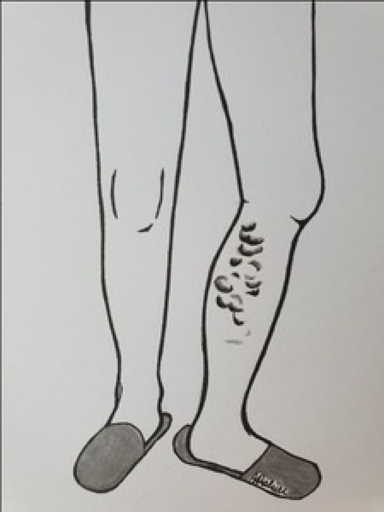 Żylaki po przyśrodkowej stronie uda i na łydce