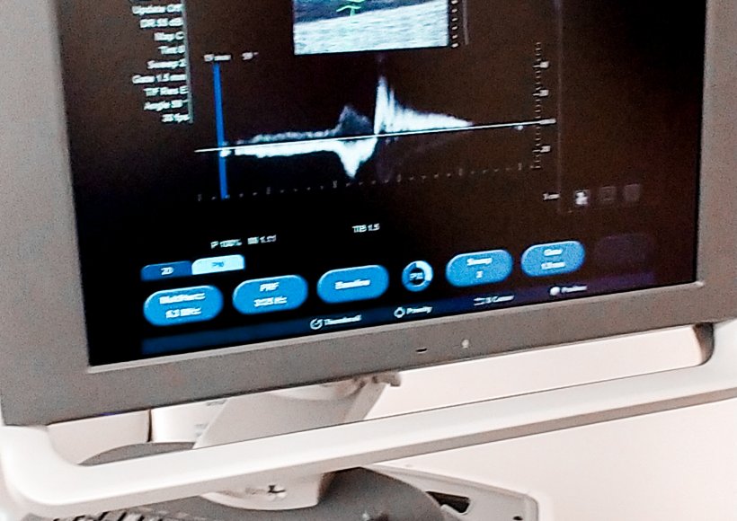 Co łączy zastawki żylne i regał na książki ? Refluks żylny- czym jest ?