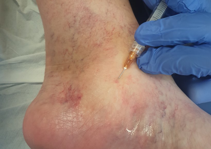 Najskuteczniejszy zabieg na pajączki.