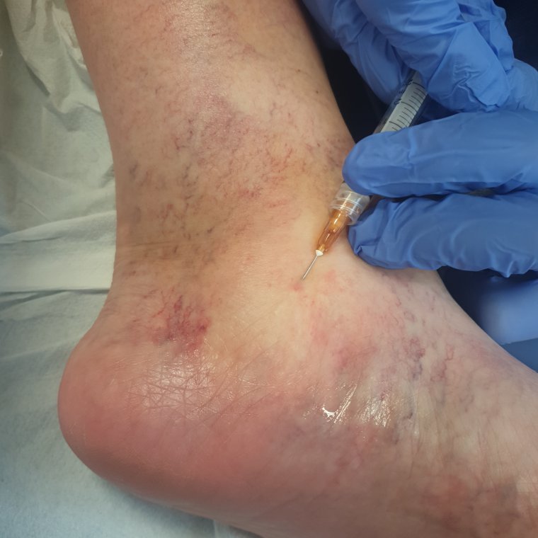 Najskuteczniejszy zabieg na pajączki.