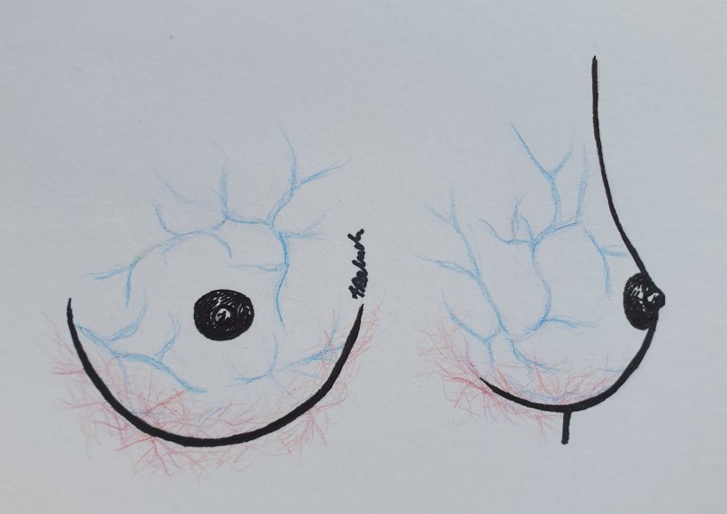 Poszerzone naczynia na piersiach