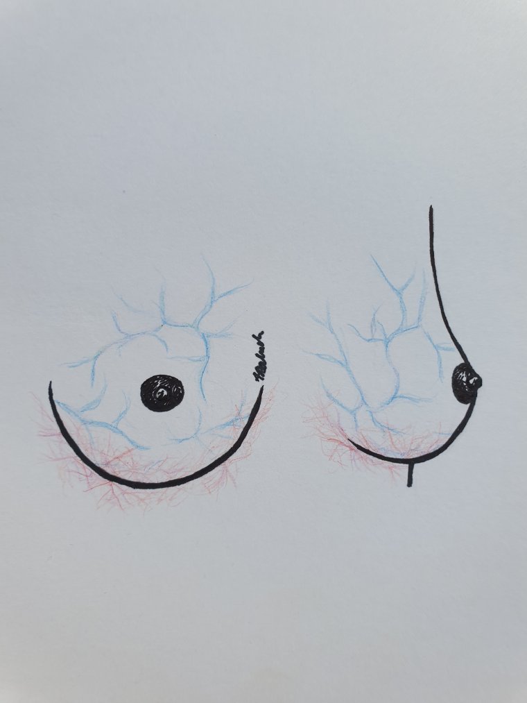 Poszerzone naczynia na piersiach