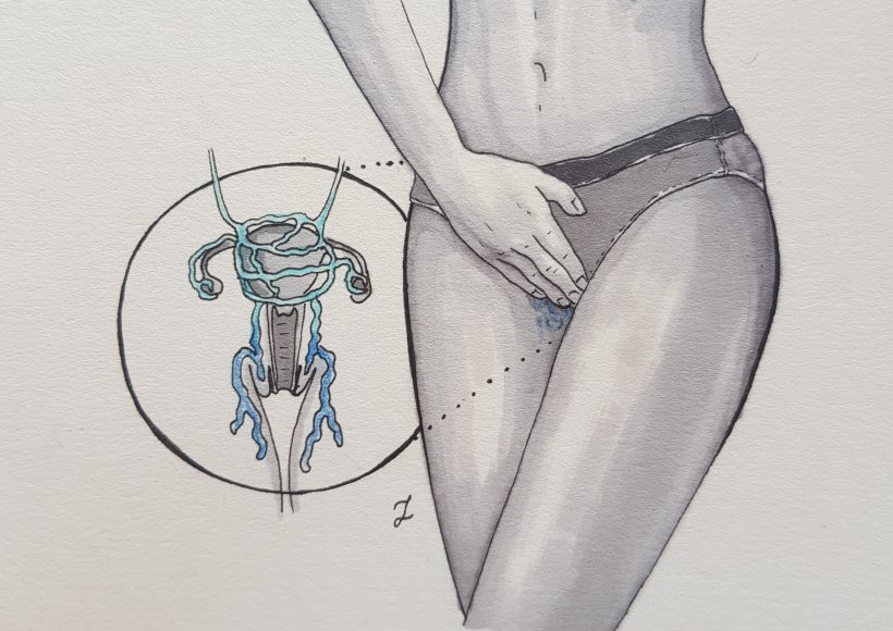 Żylaki miejsc intymnych 