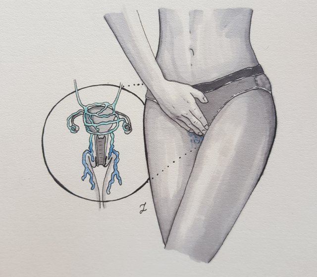 Żylaki miejsc intymnych 