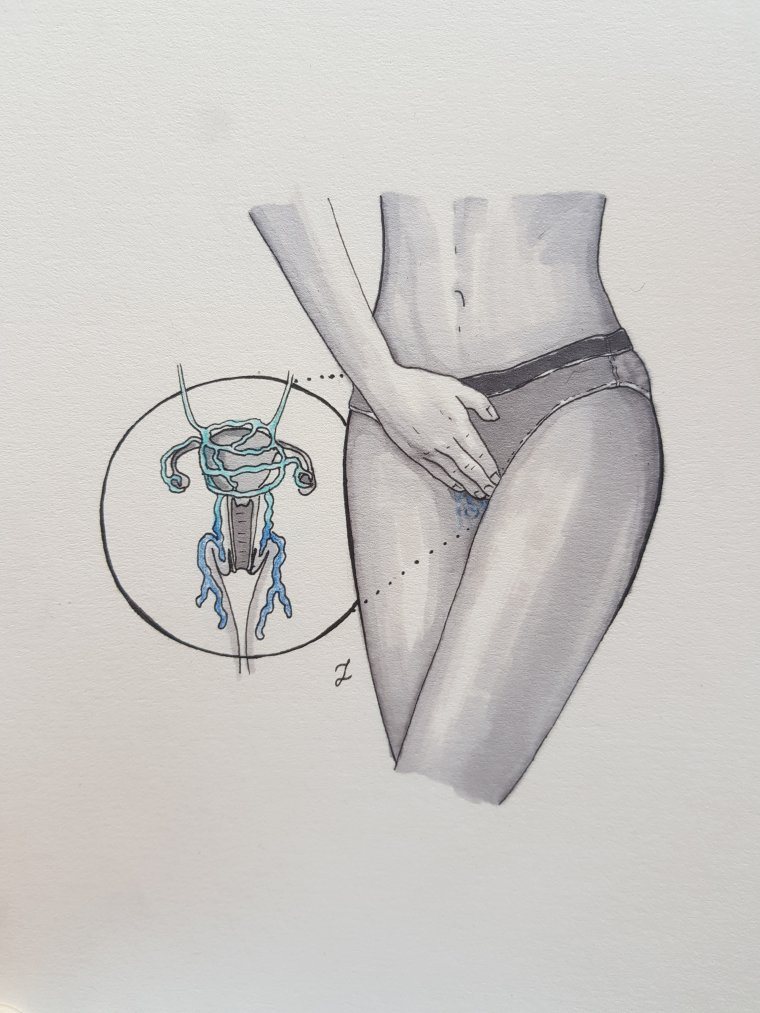 Żylaki miejsc intymnych 