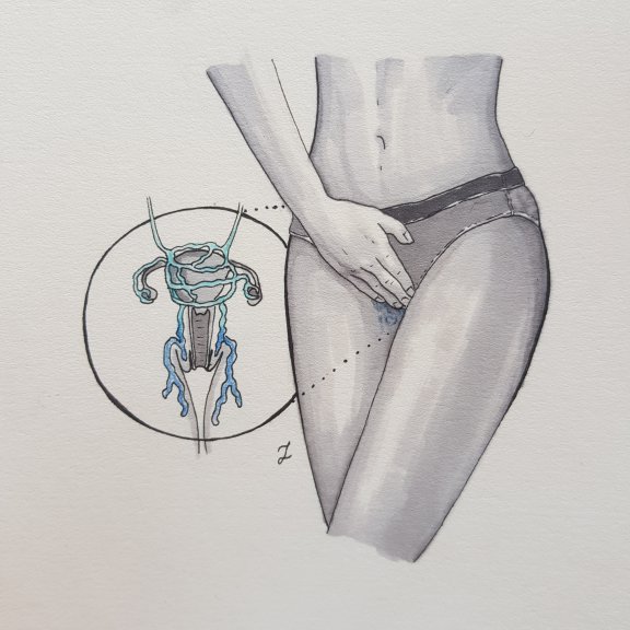 Żylaki miejsc intymnych 