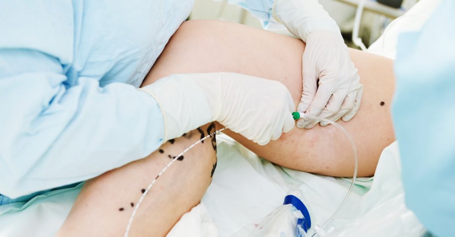 Zabieg usuwania żylaków za pomocą fal radiowych