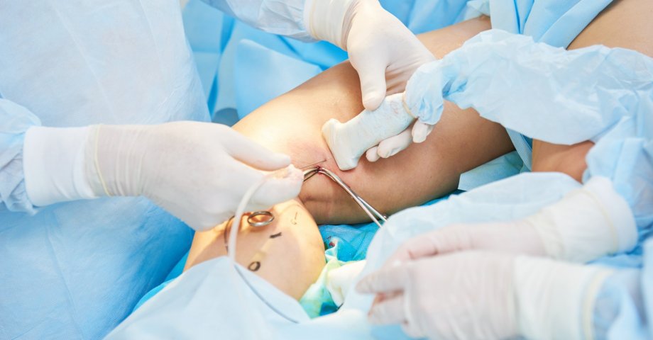 Zabieg laserowego usuwania żylaków