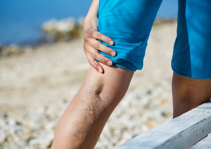 Dlaczego powinniśmy leczyć niewydolne żyły?