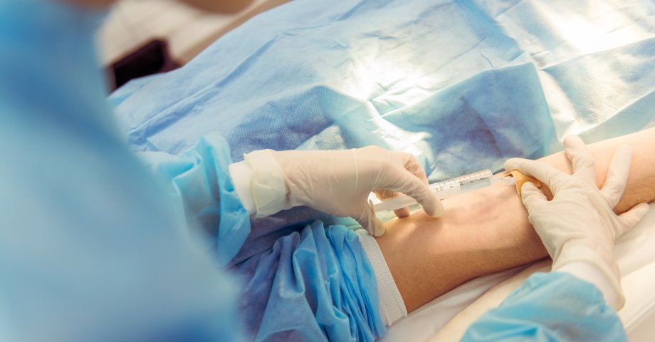 Zabieg usuwania żylaków za pomocą skleroterapii